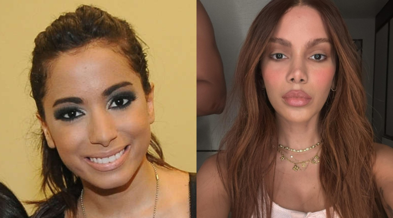 Cirurgias plásticas dos famosos: antes e depois chocantes!