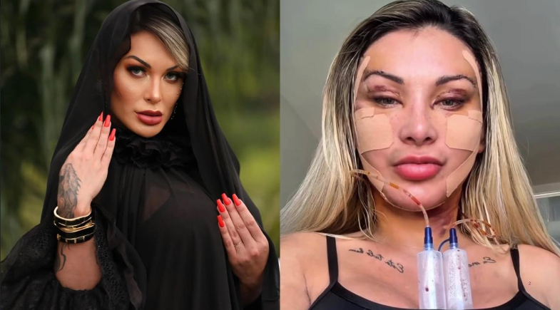 Andressa Urach mostra rosto após fazer 50ª cirurgia: ''Investi pesado'' 