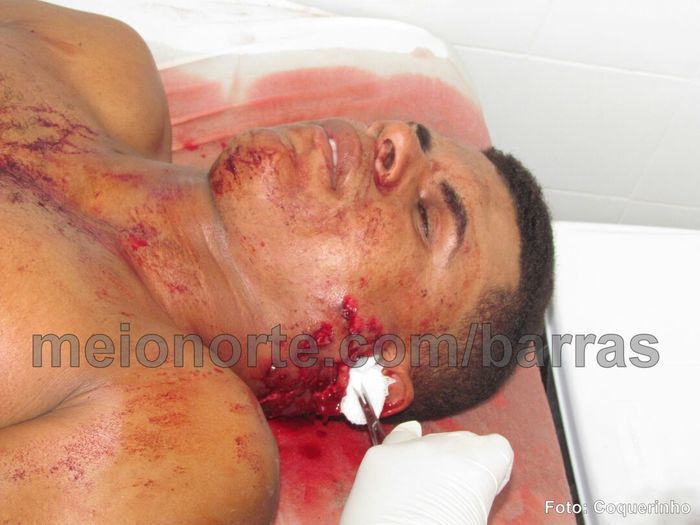 Durante briga, homem é atingido por tiro de espingarda em Barras - Imagem 3