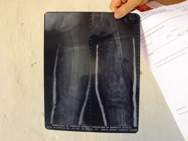 Criança com ossos de vidros no Piauí precisa de ajuda. - Imagem 20