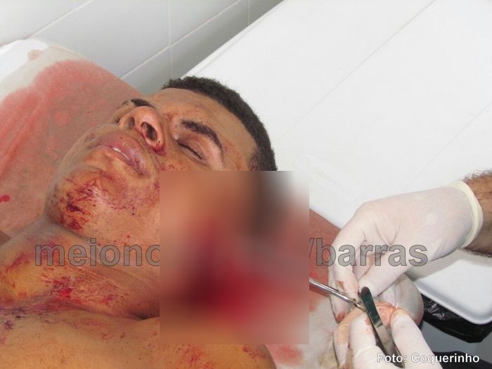 Durante briga, homem é atingido por tiro de espingarda em Barras - Imagem 1