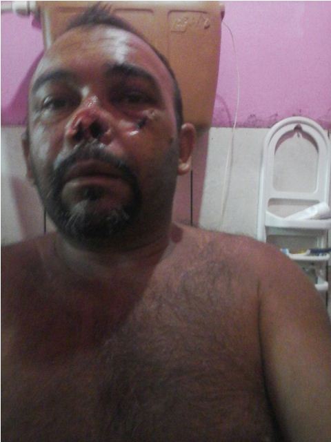 Homem é atingido com golpe de facão e tem parte do nariz decepado - Imagem 2