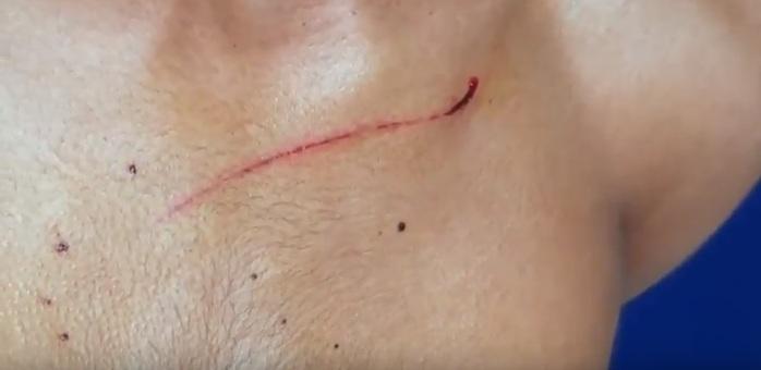 Menor sofreu um pequeno corte no peito. (Crédito: Kairo Amaral)