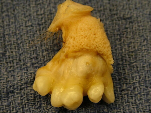 Teratoma: conheça os impressionantes tumores que têm dentes e até ...