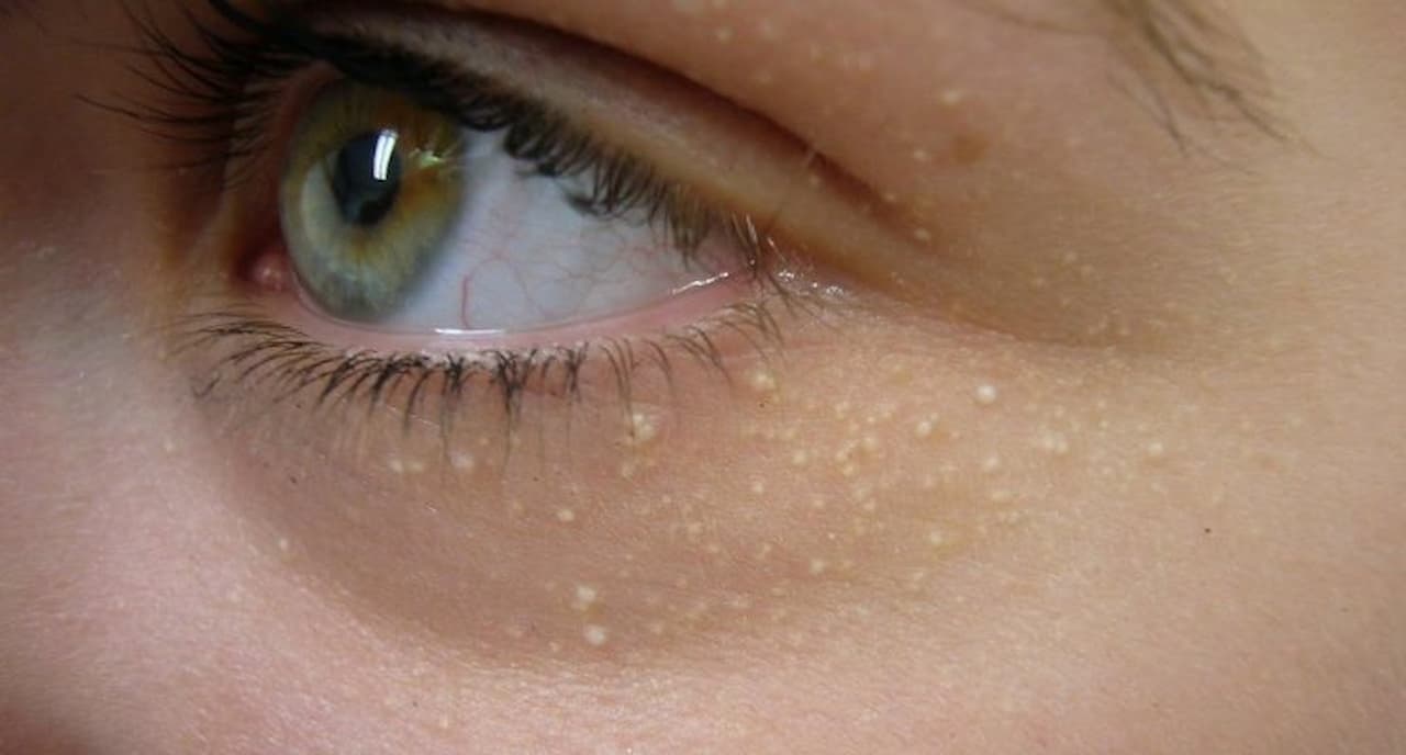 5 sinais na pele que indicam colesterol alto e precisam de atenção | Bem  Estar, image size:1280x688