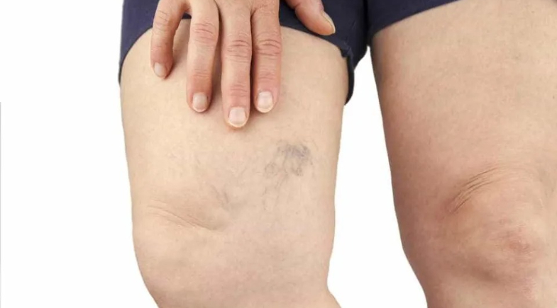 Varizes: Mitos e verdades sobre o desconforto nas pernas | Reprodução