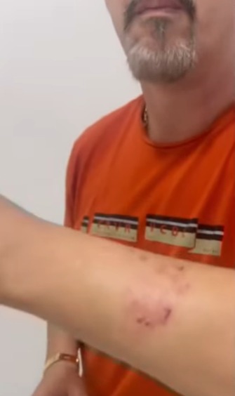 Policial Amarildo Carlos levou mordida após capturar suspeito de tráfico | Foto: Reprodução
