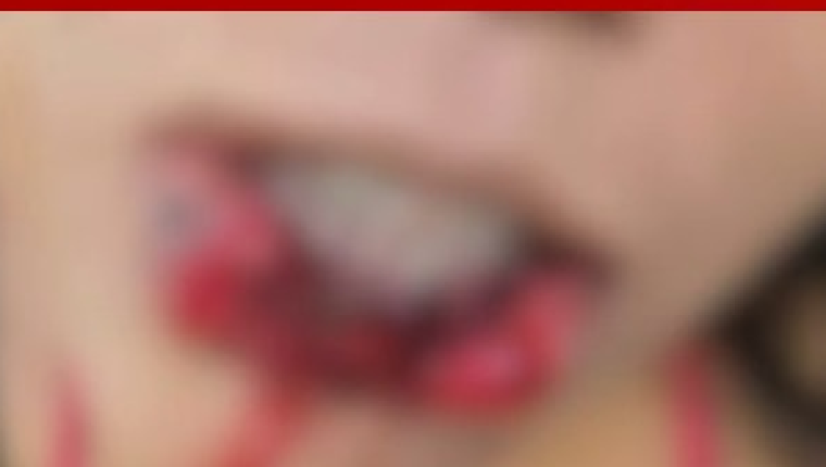 Imagem mostra parte do lábio da jovem arrancado pelo namorado