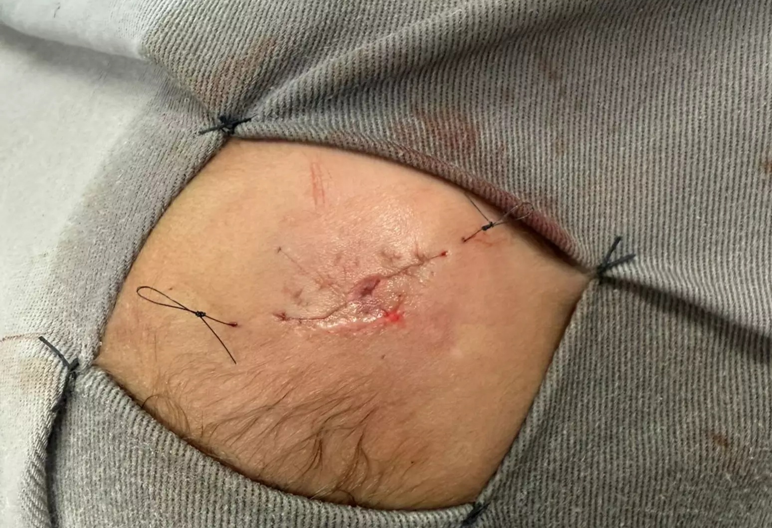 Foto do cránio da criança pós-cirurgia no Hospital São João de Deus (Foto: Reprodução)