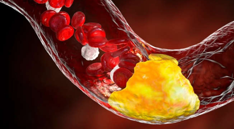 Entupimento das artérias | Reprodução