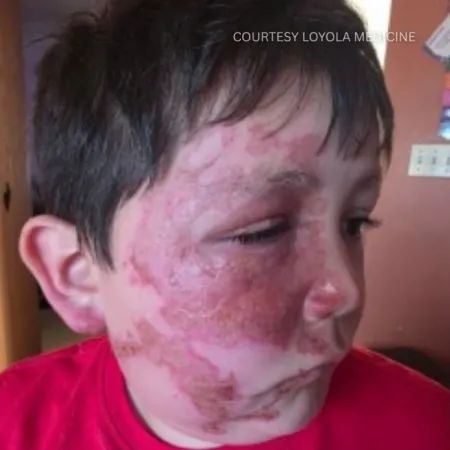 Foto:Cortesia/Loyola Medicine - Caleb sofreu queimadruas de 2º grau