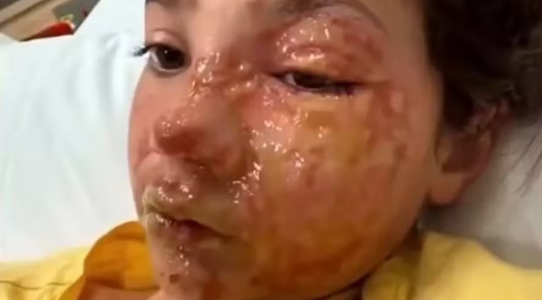 Menina do 10 anos fica com queimaduras no rosto após participar de desafio viral
