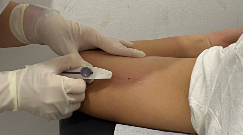 Prefeitura de Nazária inicia inserção de implante contraceptivo Implanon