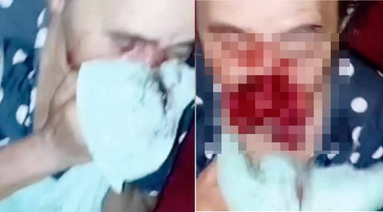 Filho morde e rasga rosto da própria mãe em ataque brutal no Maranhão | Reprodução
